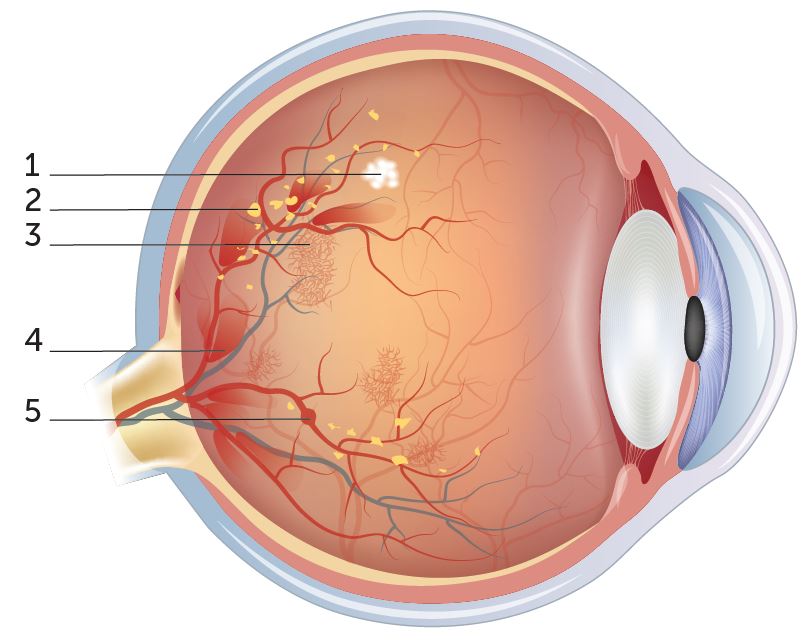 Illustration d’un œil atteint de rétinopathie diabétique. Un foyer de nodules cotonneux blancs, des dépôts jaunâtres (exsudats), de nouveaux vaisseaux sanguins fins, des hémorragies en flammèches et un micro-anévrisme (petite protubérance d’une veine) sont visibles.