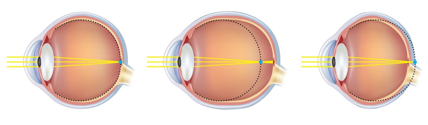 Normalsichtiges kurzsichtiges und weitsichtiges Auge