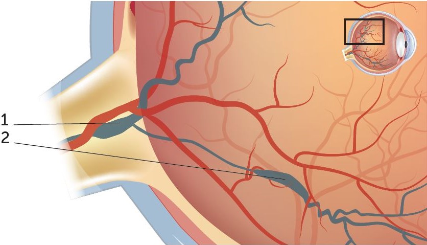 Grafischer Ausschnitt des hinteren Augapfels bei einem retinalen Venenverschluss. Die in blau dargestellten Venen werden von Arterien abgedrückt, das Blut staut sich zurück, die Vene ist gleich hinter dem Verschluss verdickt, dahinter schlängelt sie sich.